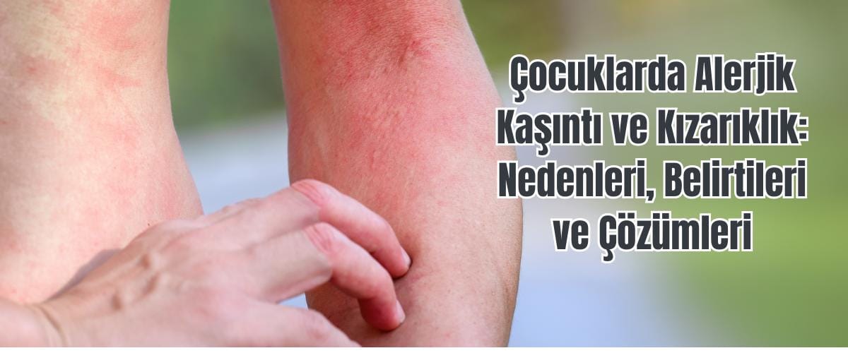 Çocuklarda Alerjik Kaşıntı ve Kızarıklık Nedenleri Belirtileri ve