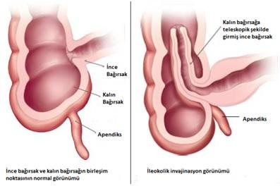 Bebeklerde Bağırsak Düğümlenmesi 