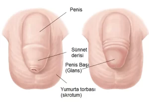 Hipospadias Peygamber Sünneti
