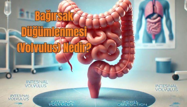 Bağırsak Düğümlenmesi (Volvulus) Nedir